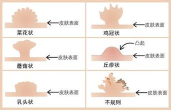 男性包皮内部长了菜花状怎么办